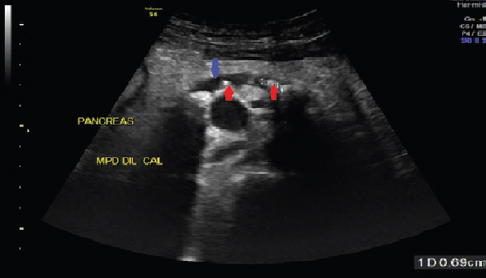 Ultrasonography of the pancreas showing parenchymal atrophy, ductal dilatation (blue arrow) and intraductal calculi (red arrow).